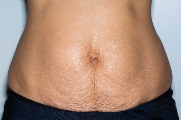 Close-up of a person’s tummy showing a number of creases in the skin under their belly button. Shown on light brown skin.